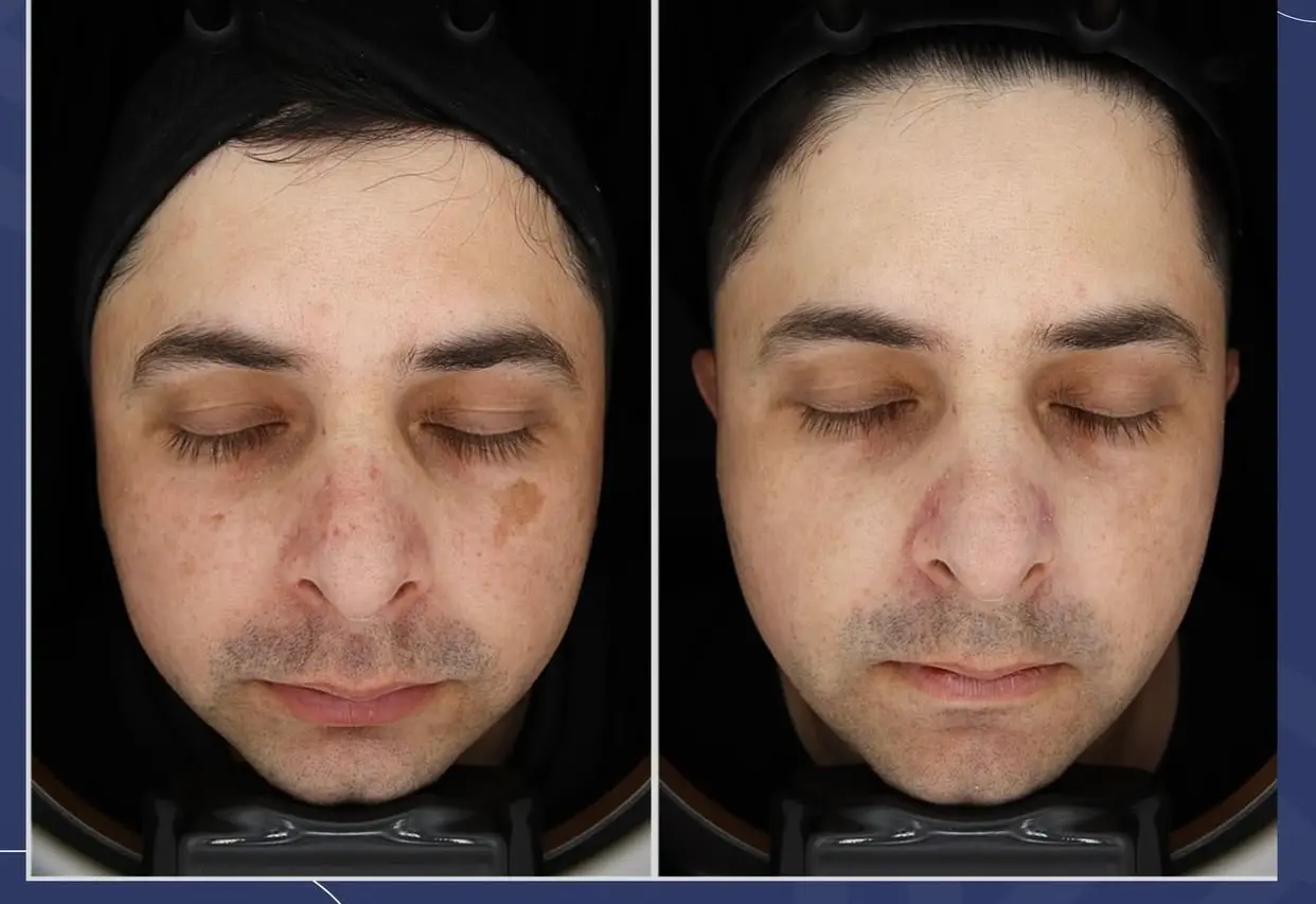 Resultado de tratamiento de manchas - Bioestimulación